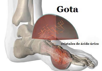 ¿QUÉ ES EL ÁCIDO ÚRICO?